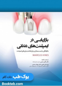 marketing_in_dental_implants_how_to_persuade_patients_to_do_implant_treatments